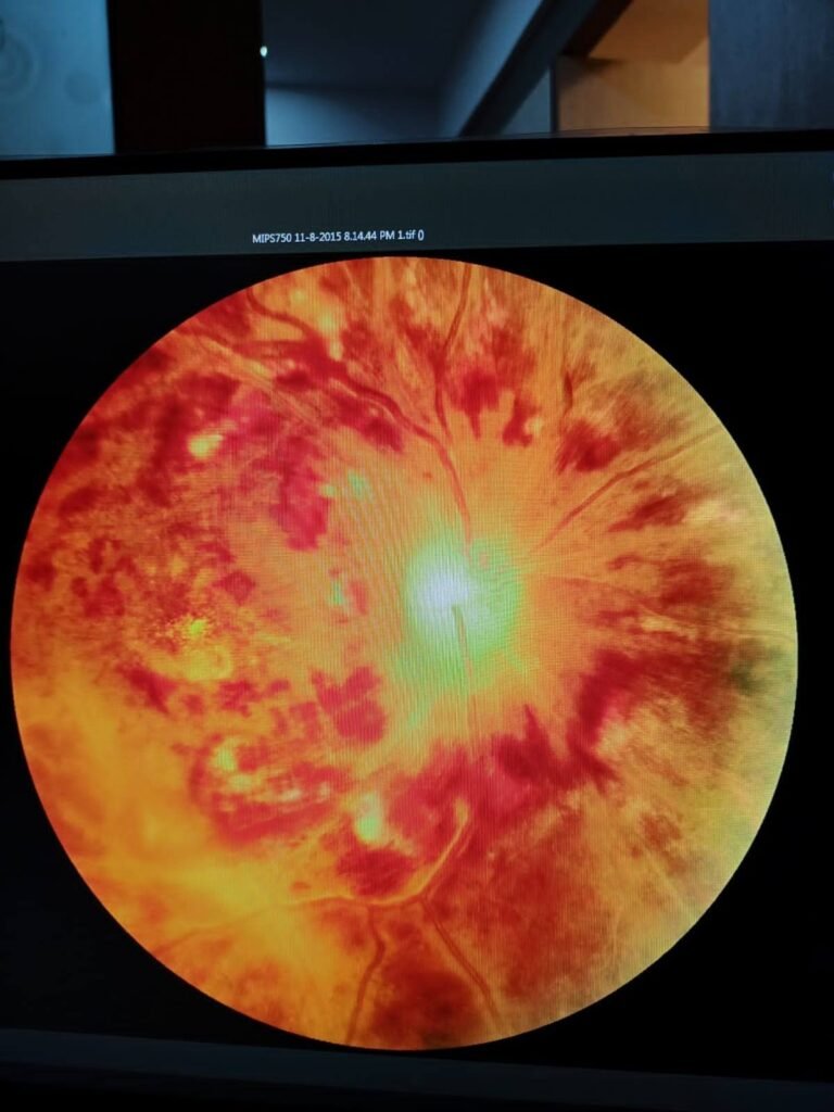 Diabetic Retinopathy Retina View