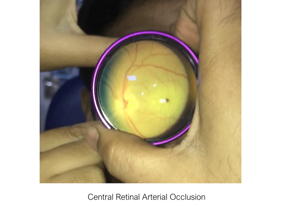 Central-Retinal-Arterial-Occlusion-CRAO
